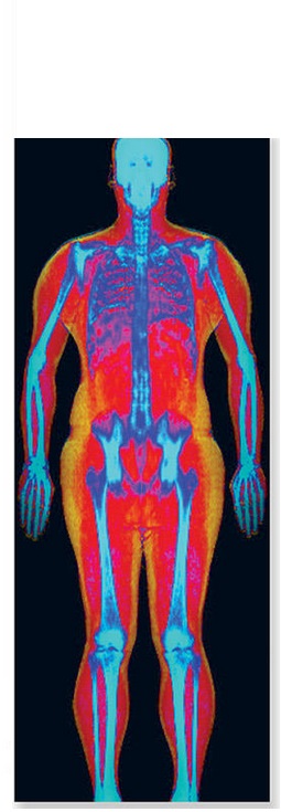 Les chercheurs ont numérisé la densité osseuse et la composition corporelle par absorptiométrie biphotonique à rayons X
